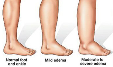 Read more for Ayurvedic Treatment of Anaemia Disease