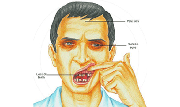 Read more for Ayurvedic Treatment of Anaemia Disease