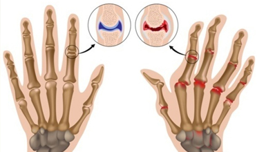 Read more for Ayurvedic Treatment of Anaemia Disease