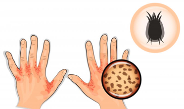 Read more for Ayurvedic Treatment of Anaemia Disease