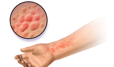Read more for Ayurvedic Treatment of Anaemia Disease