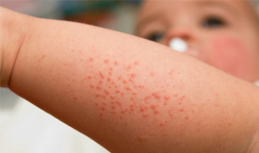 Read more for Ayurvedic Treatment of Anaemia Disease