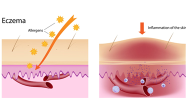 Read more for Ayurvedic Treatment of Anaemia Disease