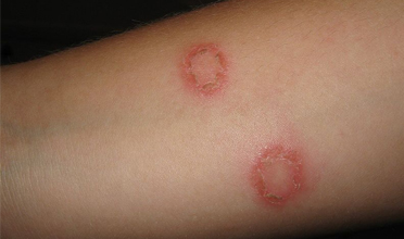 Read more for Ayurvedic Treatment of Anaemia Disease